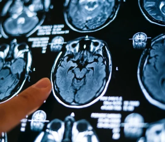 Avem, din naștere, în corpul nostru acel „ceva” care ne-ar putea ține departe de Alzheimer